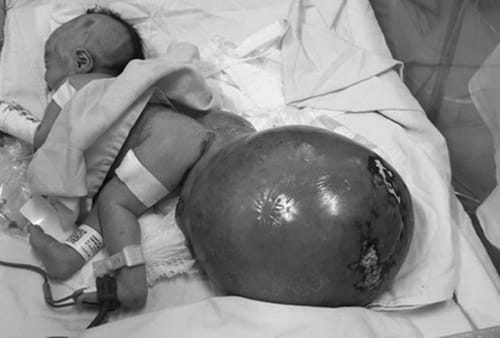 BV Nhi đồng 1 phẫu thuật cho bé gái có khối bướu nặng 3,1 kg