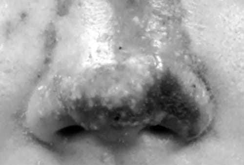 Tân trang sắc đẹp: Nữ bệnh nhân hối hận vì bị hoại tử mũi